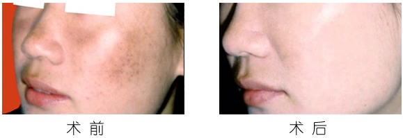 激光祛斑后需要多少钱