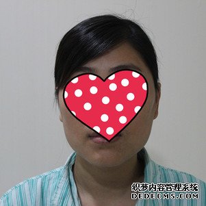 【真人案例】上海华美医疗美容医院李志海医生磨骨瘦脸案例:下颌角+颧骨整形"