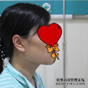 【真人案例】上海华美医疗美容医院李志海医生磨骨瘦脸案例:下颌角+颧骨整形2"