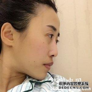 【真人案例】北京焕誉医疗美容门诊部王征医生丰额头案例:自体脂肪填充部(额头+太阳穴+泪沟+法令纹+面颊)3"