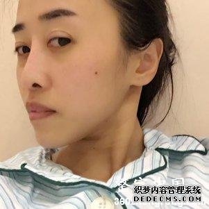 【真人案例】北京焕誉医疗美容门诊部王征医生丰额头案例:自体脂肪填充部(额头+太阳穴+泪沟+法令纹+面颊)2"