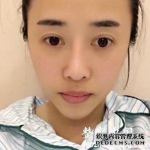 【真人案例】北京焕誉医疗美容门诊部王征医生丰额头案例:自体脂肪填充部(额头+太阳穴+泪沟+法令纹+面颊)"